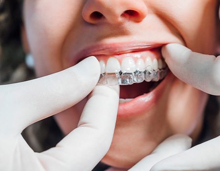 Dentist placing Invisalign aligner on patient