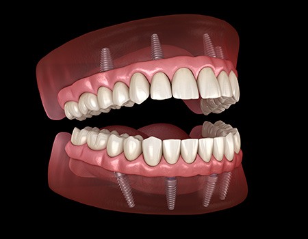 A 3D illustration of All-on-4 dentures