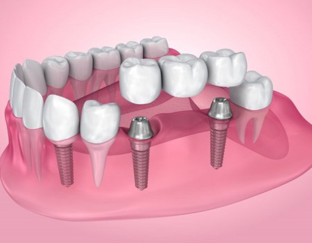 Exploded illustration of dental implants with bridge and crown