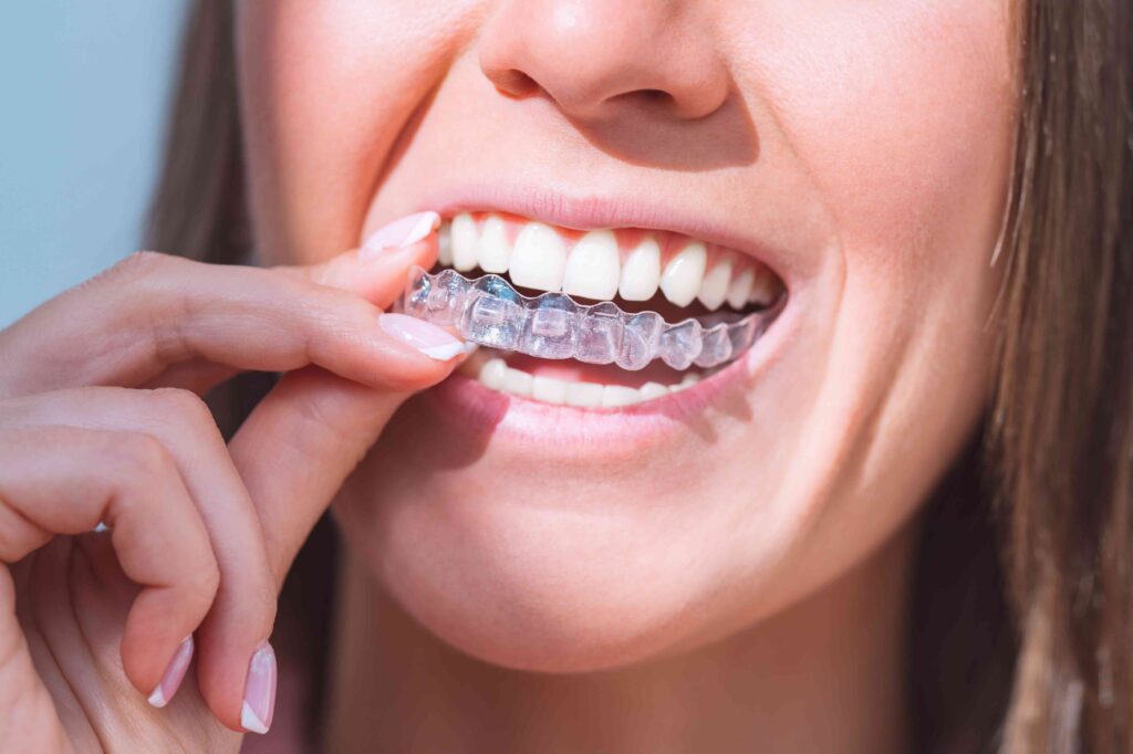 Woman putting in Invisalign